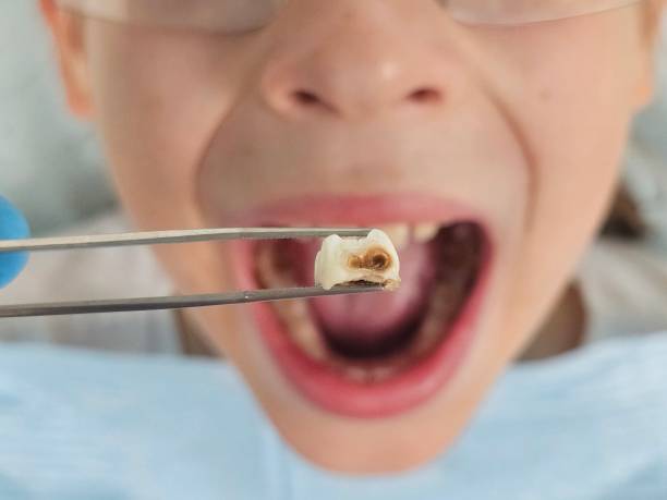 Best Emergency Tooth Extraction in Hughestown, PA